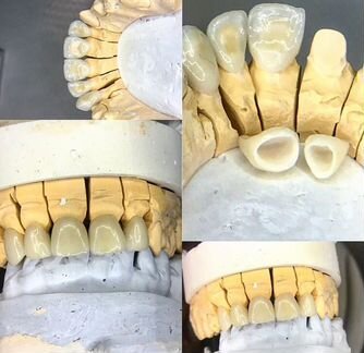 Зуботехнические работы. Зубной техник ортопедия