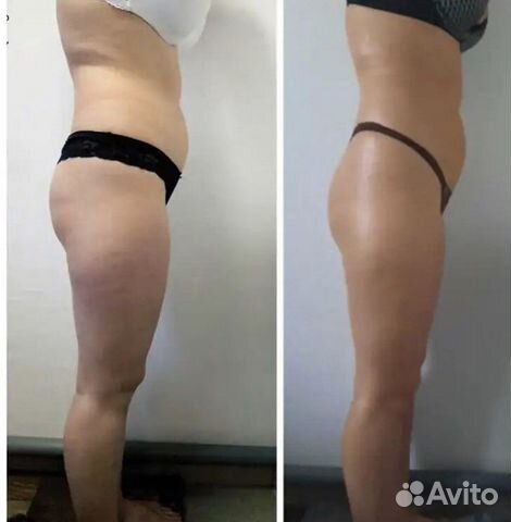 Антицеллюлитный массаж